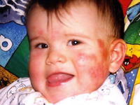 Baby Eczema