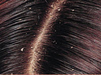 Dandruff Scalp