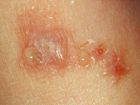 Dermatitis picture