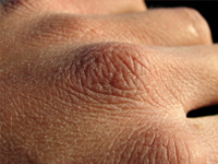 Dry Itchy Skin