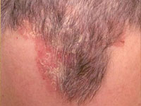 Scalp Psoriasis