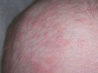 Scalp Eczema